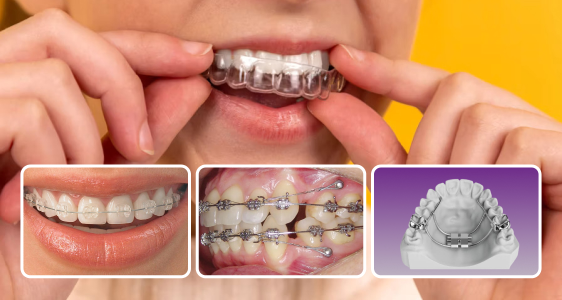 Aligners dhe trajtim ortodontik