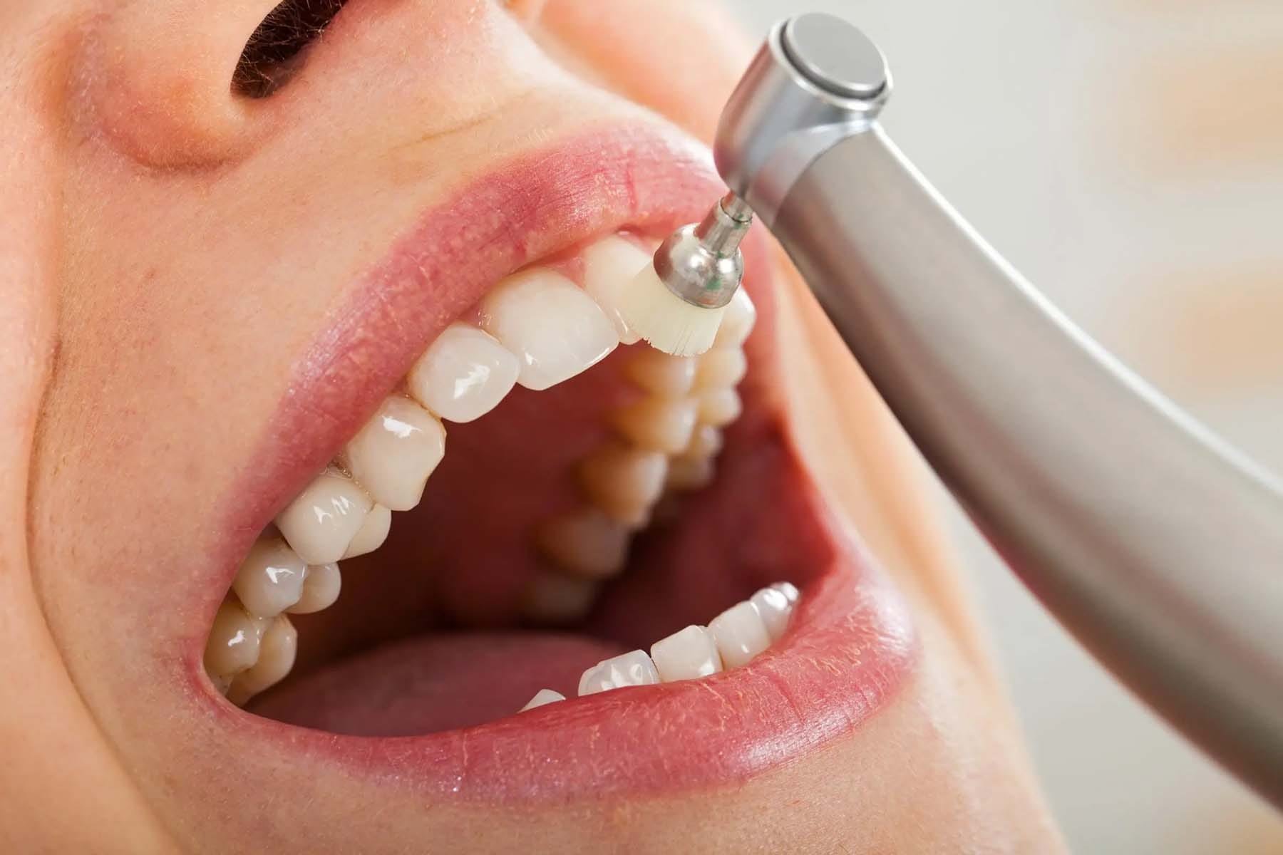 Pastrim periodik dhe kujdes preventiv dentar