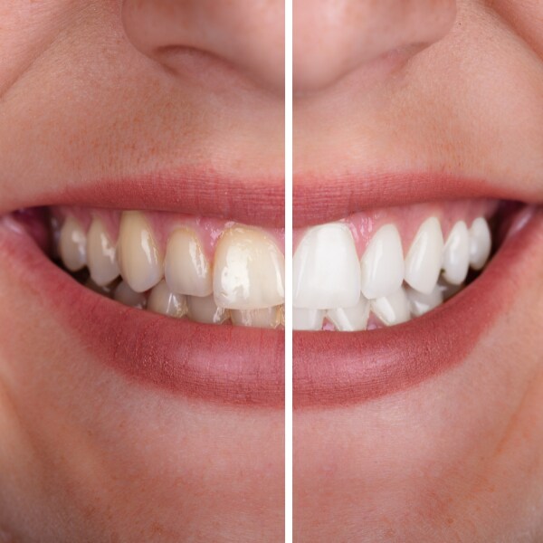 Zbardhim profesional dentar